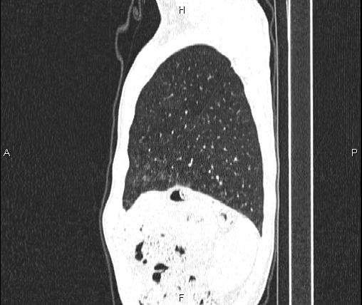 Air bronchogram in pneumonia (Radiopaedia 85719-101512 Sagittal lung window 87).jpg