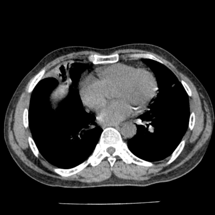 Airway foreign body in adult (Radiopaedia 85907-101779 Axial liver window 120).jpg