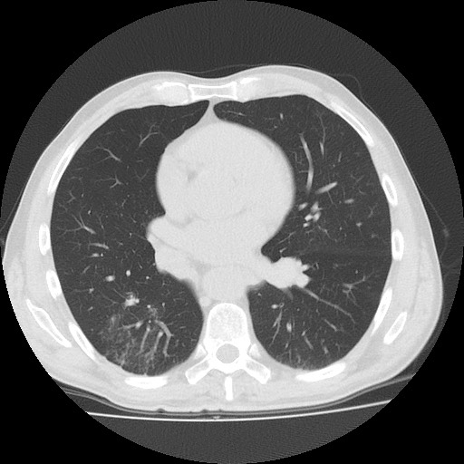 Allergic bronchopulmonary aspergillosis (ABPA) (Radiopaedia 60594-68313 Axial lung window 34).jpg