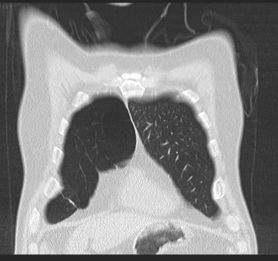 Allergic bronchopulmonary aspergillosis (Radiopaedia 44760-48571 Coronal lung window 13).png