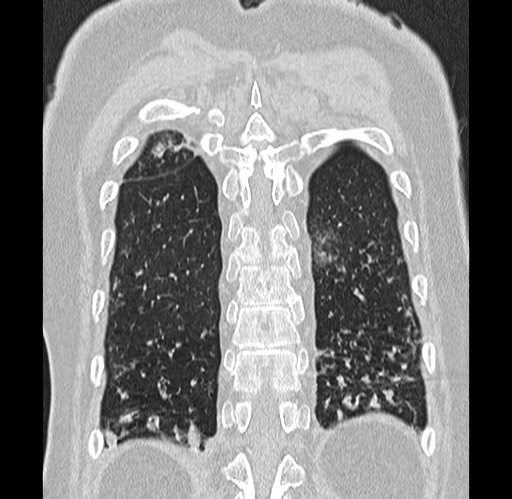 Alpha-1-antitrypsin deficiency (Radiopaedia 72058-82557 Coronal lung window 87).jpg