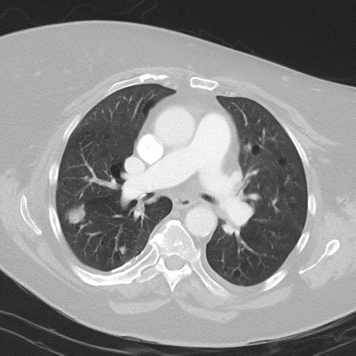 Alveolar hemorrhage and possible lymphocytic interstitial pneumonitis in systemic lupus erythematosus (Radiopaedia 28582-28839 Axial lung window 23).jpg