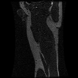 Alveolar soft part sarcoma (Radiopaedia 64501-73678 D 31).jpg
