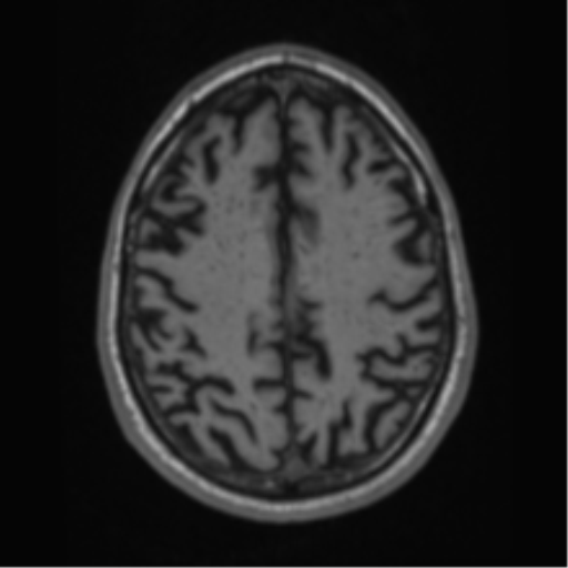 Alzheimer's disease- with Gerstmann syndrome and dressing apraxia (Radiopaedia 54882-61150 Axial T1 56).png