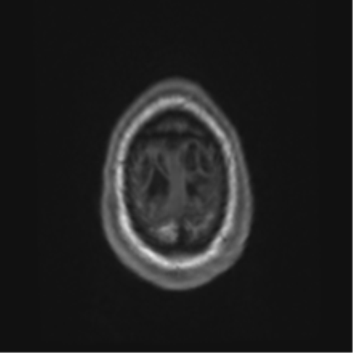 Alzheimer's disease- with Gerstmann syndrome and dressing apraxia (Radiopaedia 54882-61150 Axial T1 72).png