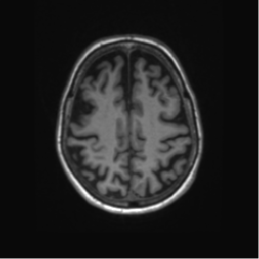 File:Alzheimer's disease (Radiopaedia 42658-45802 Axial T1 46).png