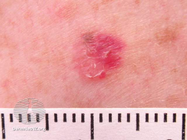 File:Amelanotic melanoma (DermNet NZ amelanotic-melanoma-015).jpg