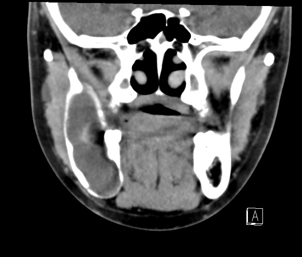 File:Ameloblastoma (Radiopaedia 26645-26793 Coronal C+ delayed 5).jpg