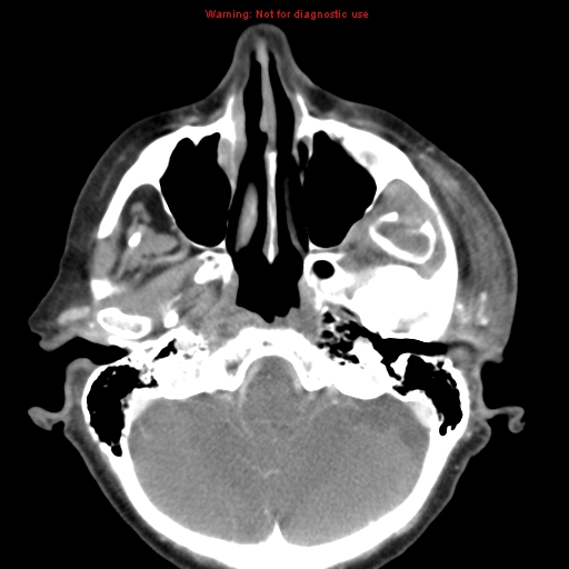 Ameloblastoma (Radiopaedia 27437-27631 A 11).jpg