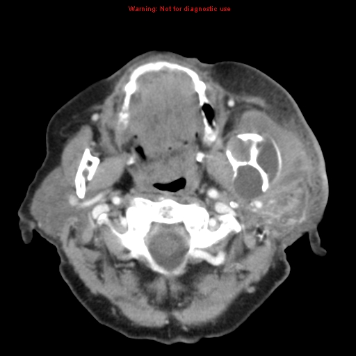 Ameloblastoma (Radiopaedia 27437-27631 A 28).jpg