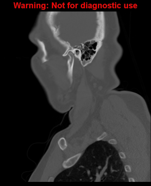 Ameloblastoma (Radiopaedia 33126-34164 Sagittal bone window 59).jpg