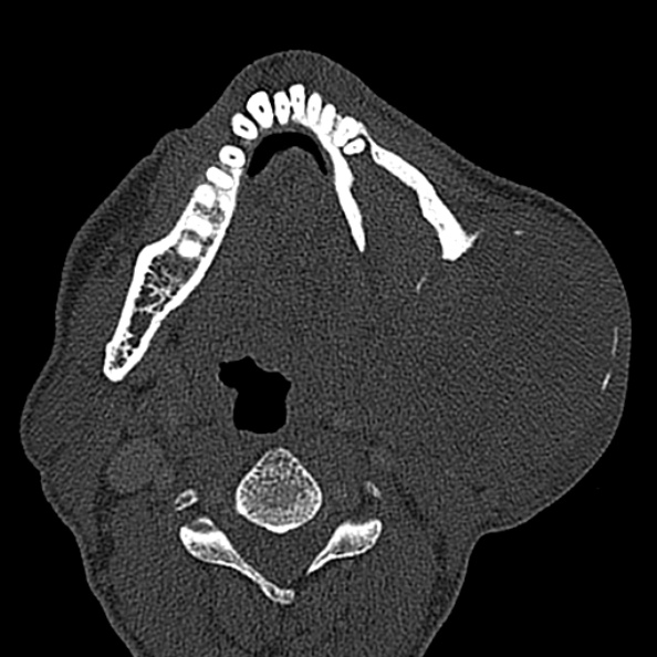 Ameloblastoma (Radiopaedia 51921-57766 Axial bone window 63).jpg