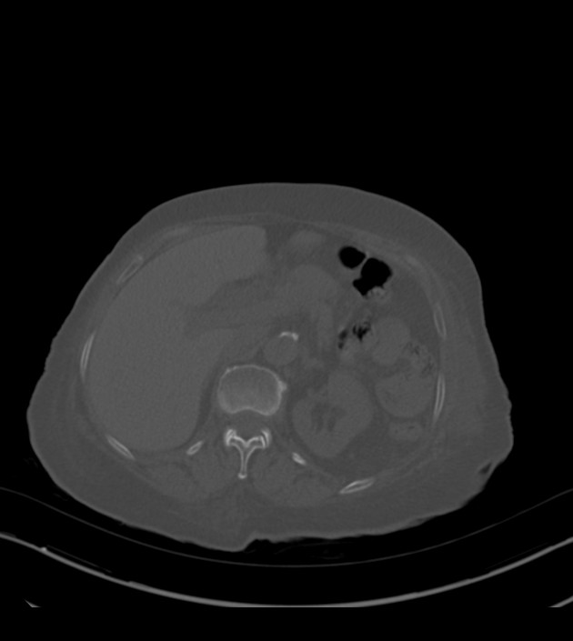 Amiodarone deposition in the liver (Radiopaedia 77587-89780 Axial bone window 89).jpg