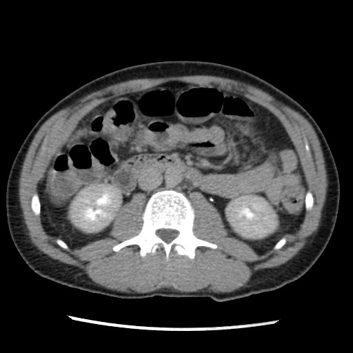 Amoebic liver abscesses (Radiopaedia 55536-62009 Axial C+ delayed 44).jpg