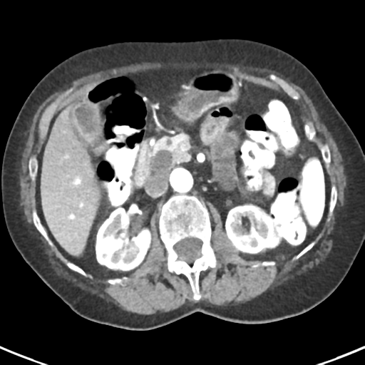 Ampullary adenocarcinoma (Radiopaedia 34013-35237 B 35).png