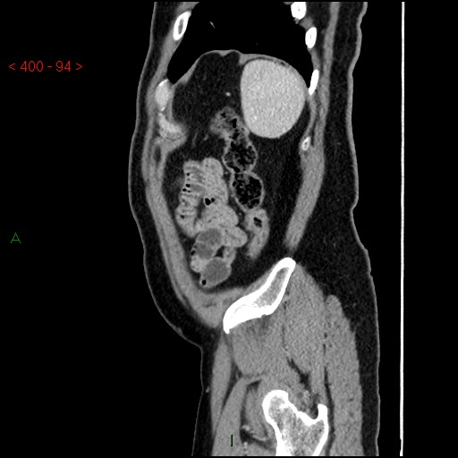 Ampullary carcinoma (Radiopaedia 56396-63056 D 93).jpg