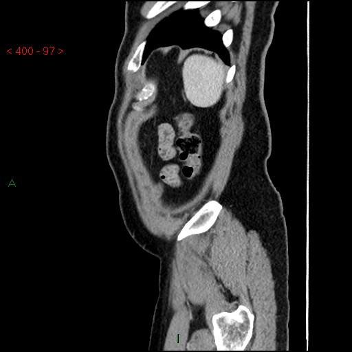 Ampullary carcinoma (Radiopaedia 56396-63056 D 96).jpg