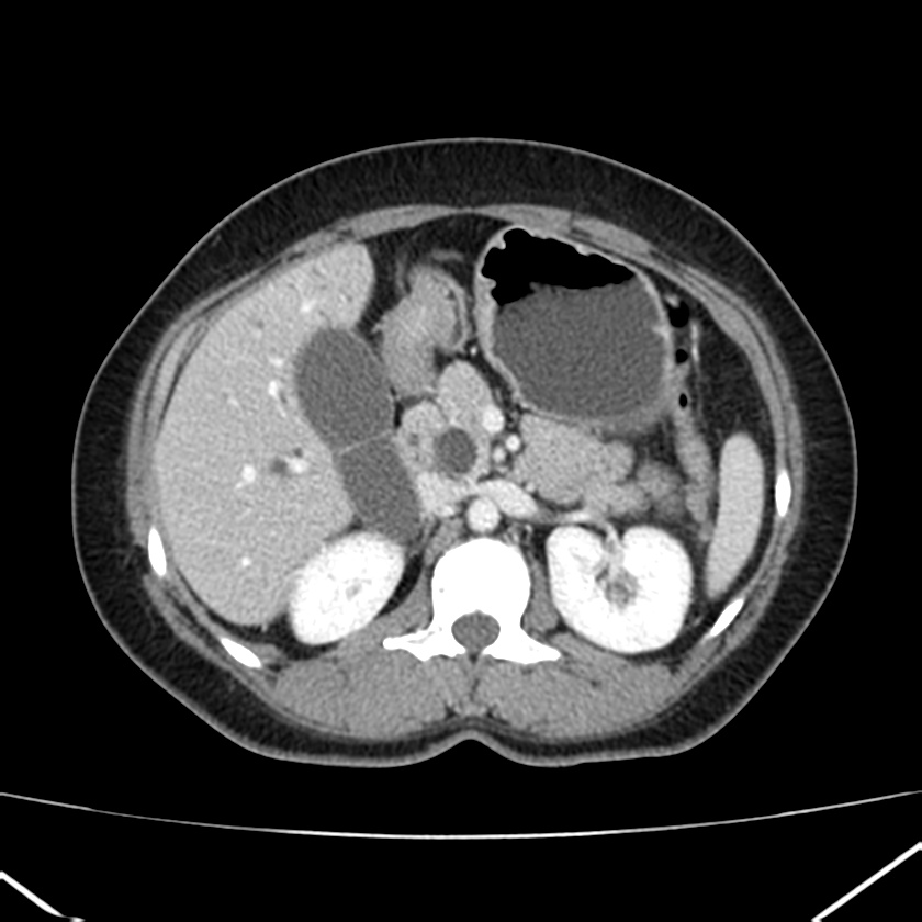 Ampullary tumor (Radiopaedia 22787-22816 C 23).jpg
