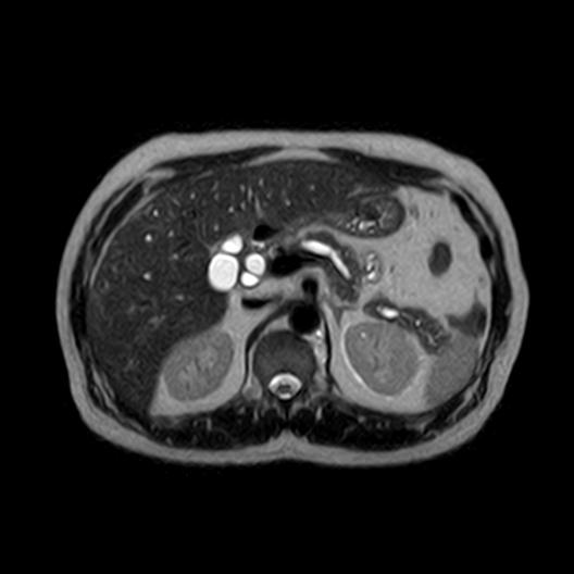 File:Ampullary tumor (Radiopaedia 27294-27479 T2 16).jpg