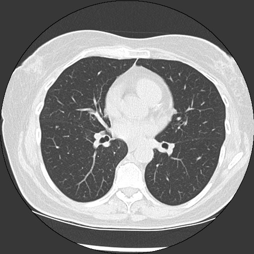 Amyloidosis - bronchial and diffuse nodular pulmonary involvement (Radiopaedia 60156-67744 B 31).jpg