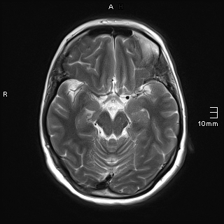 File:Amyotrophic lateral sclerosis (Radiopaedia 70821-81017 Axial T2 11).jpg
