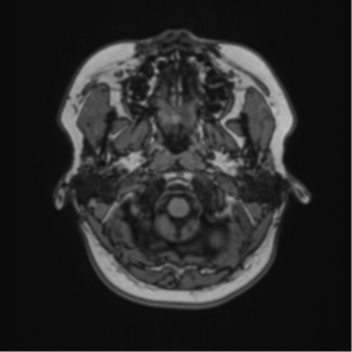 File:Anaplastic astroblastoma (Radiopaedia 55666-62194 Axial T1 6).png