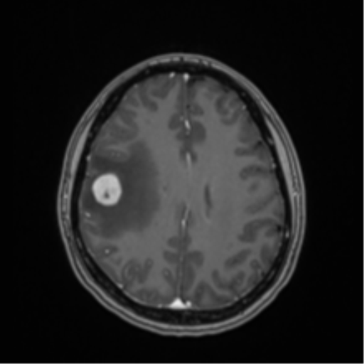 Anaplastic astroblastoma (Radiopaedia 55666-62194 Axial T1 C+ 51).png