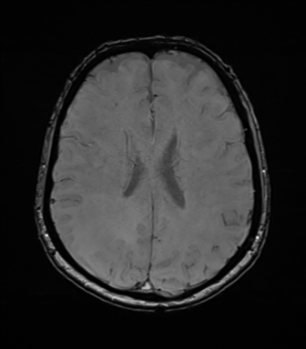 Anaplastic astrocytoma (Radiopaedia 86943-103160 Axial SWI 57).png