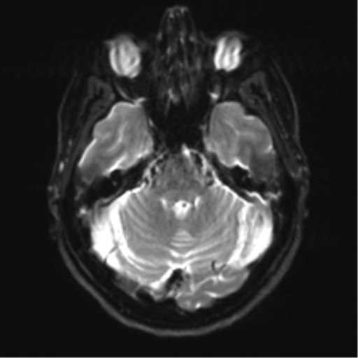 Anaplastic astrocytoma - thalamic glioma (Radiopaedia 59709-67115 Axial DWI 10).png