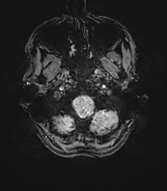 File:Anaplastic astrocytoma IDH mutant (Radiopaedia 50046-55341 Axial SWI 10).png