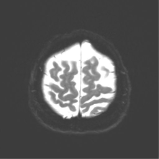 Anaplastic astrocytoma IDH wild-type (pseudoprogression) (Radiopaedia 42209-45279 Axial DWI 23).png