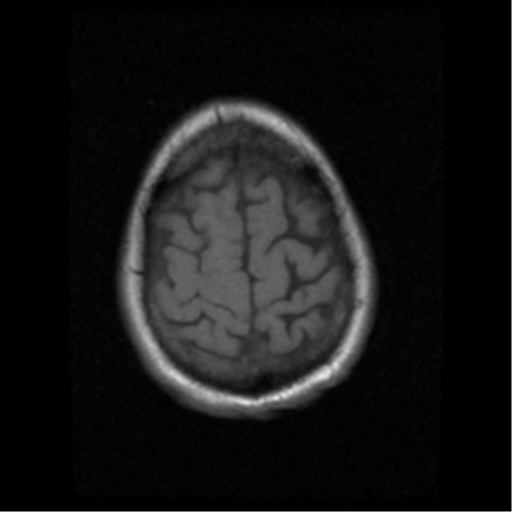 File:Anaplastic meningioma with recurrence (Radiopaedia 34452-35783 Axial T1 19).png