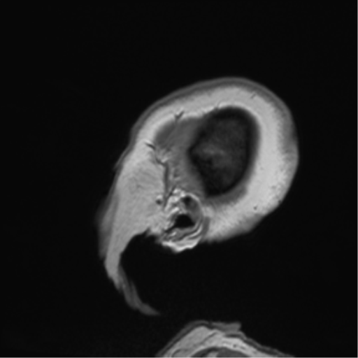 Anaplastic oligodendroglioma (Radiopaedia 83500-98599 Sagittal T1 59).png