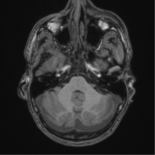 Anaplastic oligodendroglioma with skull fracture (Radiopaedia 74831-85845 Axial T1 11).png