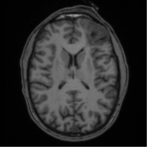 Anaplastic oligodendroglioma with skull fracture (Radiopaedia 74831-85845 Axial T1 37).png