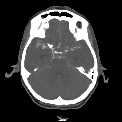 File:Aneursym related subarachnoid hemorrhage with hydrocephalus (Radiopaedia 45105-49084 A 20).jpg