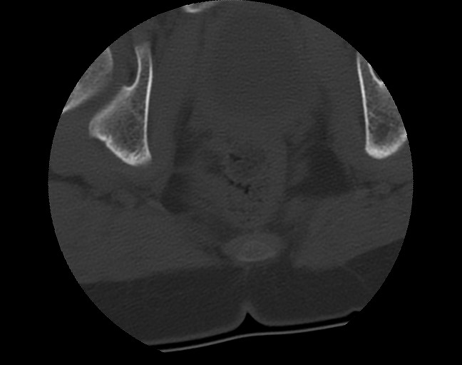 Aneurysmal bone cyst - sacrum (Radiopaedia 65190-74195 Axial bone window 49).jpg