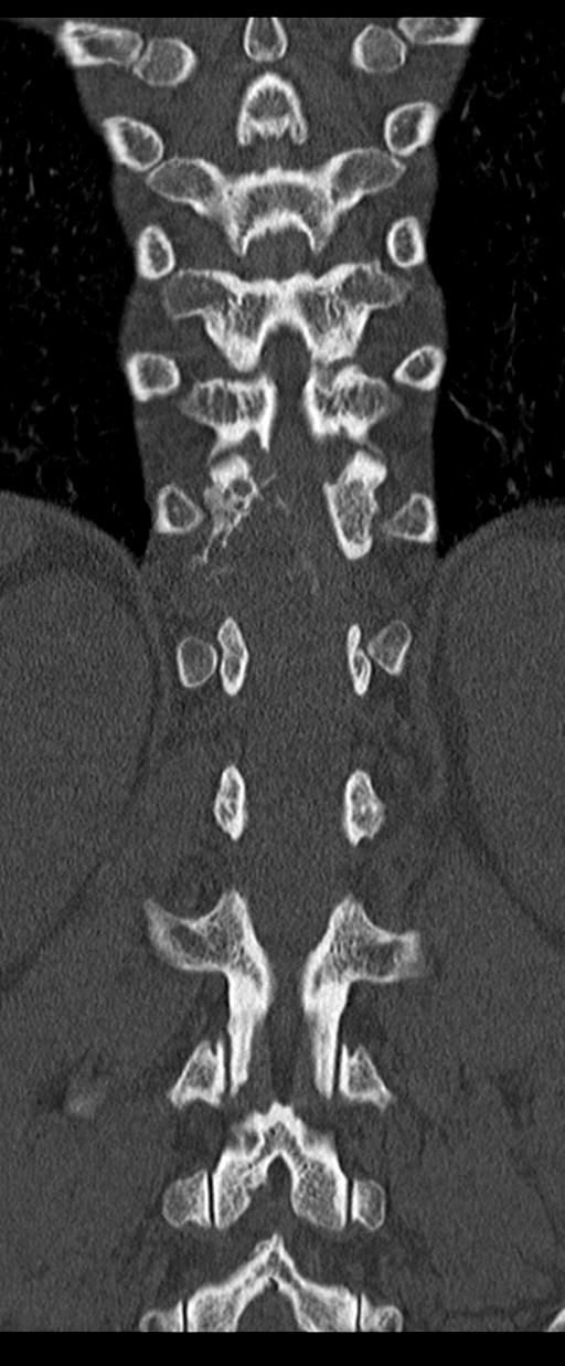 Aneurysmal bone cyst T11 (Radiopaedia 29294-29721 Coronal bone window 43).jpg