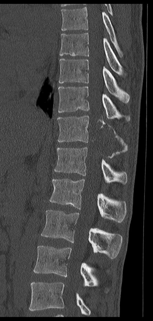 Aneurysmal bone cyst T11 (Radiopaedia 29294-29721 Sagittal bone window 40).jpg
