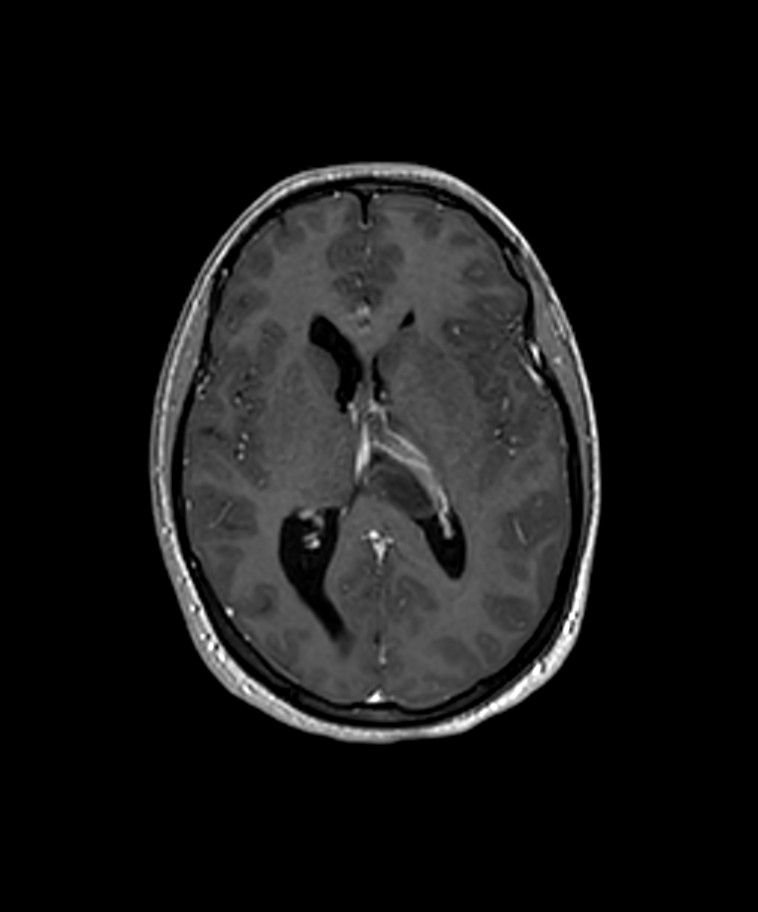 Angiomatous meningioma (Radiopaedia 79459-92577 Axial T1 C+ 3D ISO 4).jpg
