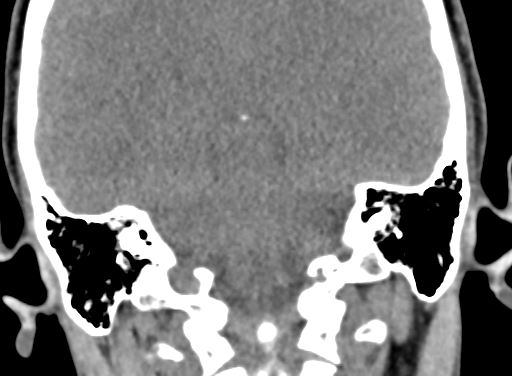 Angular dermoid cyst (Radiopaedia 88967-105790 Coronal non-contrast 84).jpg