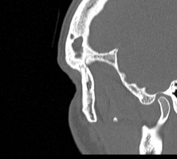 Angular epidermoid cyst (Radiopaedia 46908-51439 Sagittal bone window 91).png