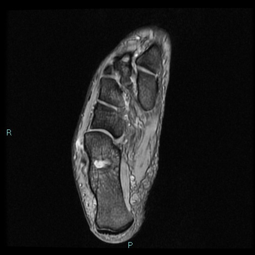 Ankle ganglion cyst (Radiopaedia 62809-71162 Axial Gradient Echo 23).jpg