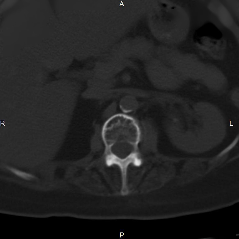 Ankylosing spondylitis (Radiopaedia 8748-9556 Axial bone window 22).jpg