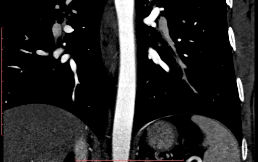 Anomalous left coronary artery from the pulmonary artery (ALCAPA) (Radiopaedia 70148-80181 B 247).jpg