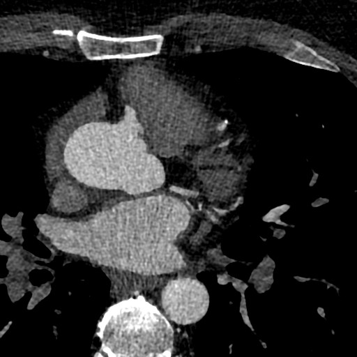 File:Anomalous origin of the left coronary artery with malignant course (Radiopaedia 77842-90126 C 47).jpeg
