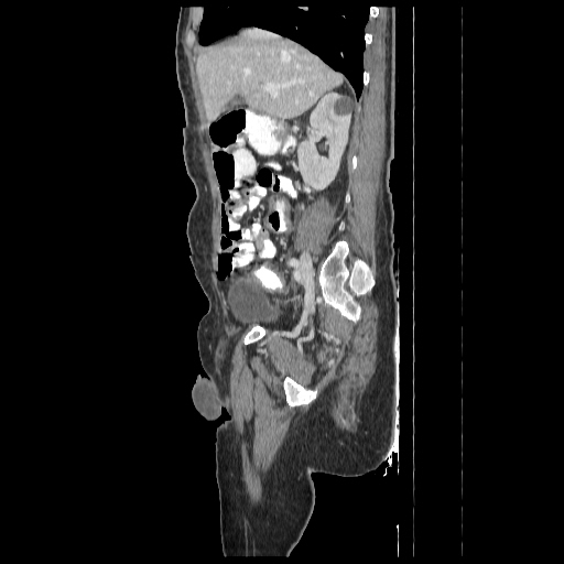 Anorectal carcinoma (Radiopaedia 44413-48064 C 34).jpg