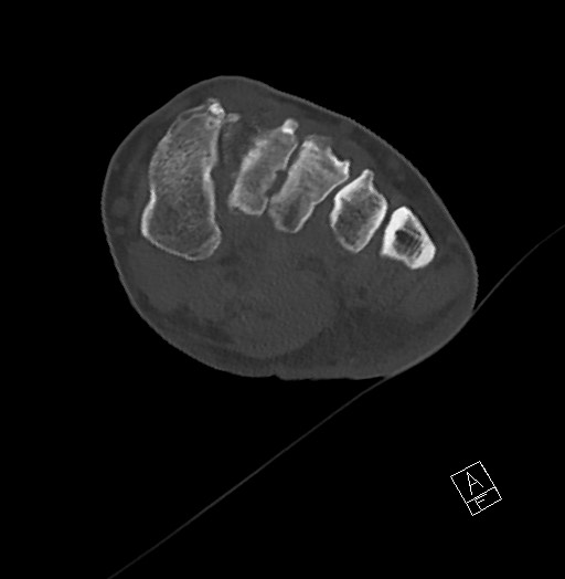 Anterior calcaneal process fracture (Radiopaedia 63353-71943 Axial bone window 74).jpg