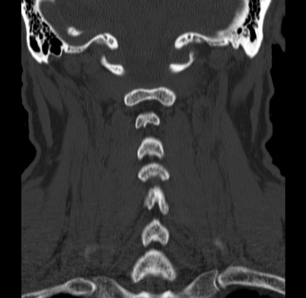Anterior cervical postdiscectomy arthrodesis (Radiopaedia 32678-33646 Coronal bone window 48).jpg