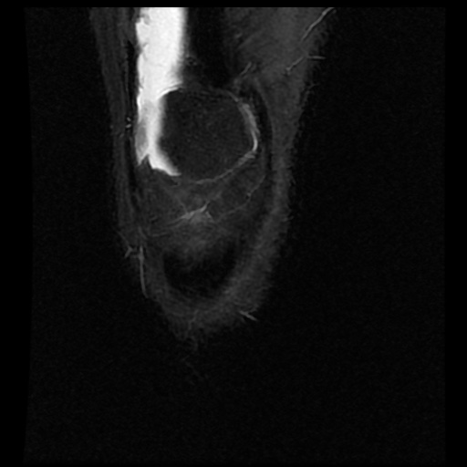File:Anterior cruciate ligament avulsion fracture (Radiopaedia 58939-66193 Coronal STIR 3).jpg